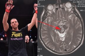Rafael-Lovato-et-sa-maladie-c&eacute;r&eacute;brale